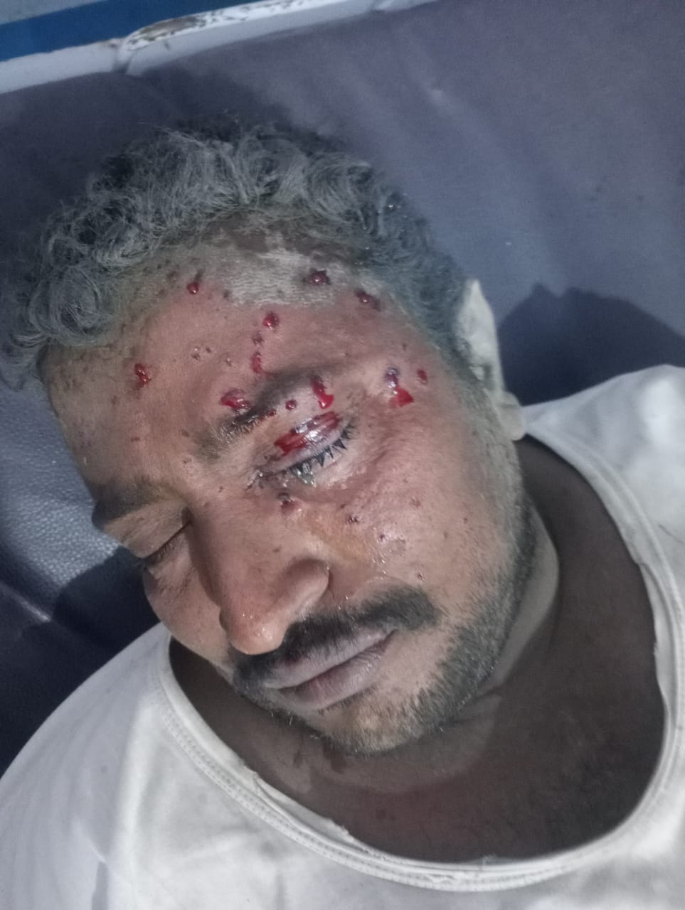 إصابة مواطن بجروح جراء انفجار لغم زرعته مليشيات الحوثي شرق مديرية حيس